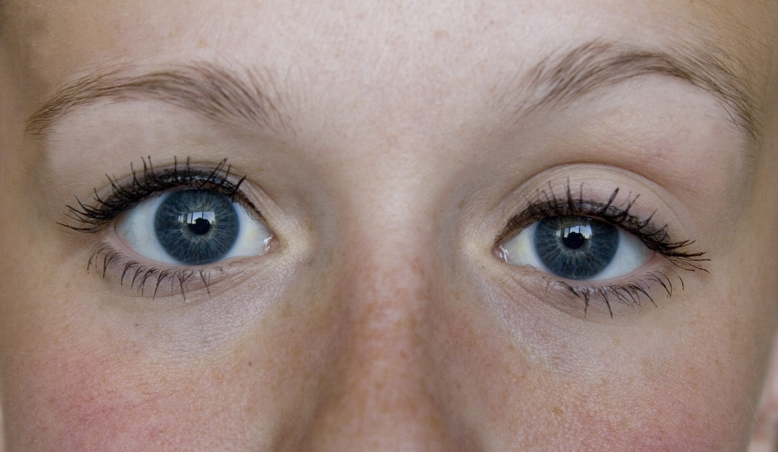 What Is Blepharoplasty, and How Can It Help You Look Your Best