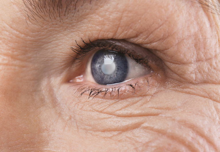 An illustration of the retina with signs of diabetic retinopathy