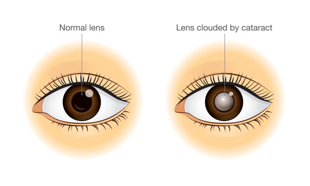 cataract-infographic