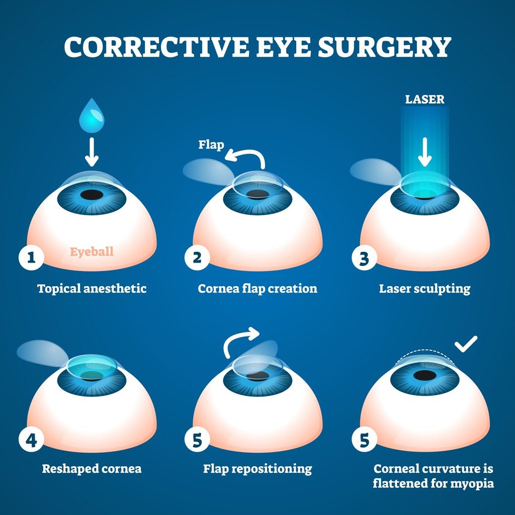 corrective-eye-surgery-infographic