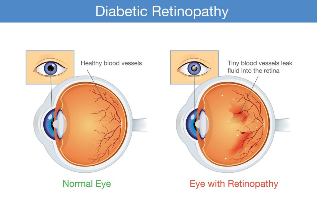 diabetic-retinopathy-infographic