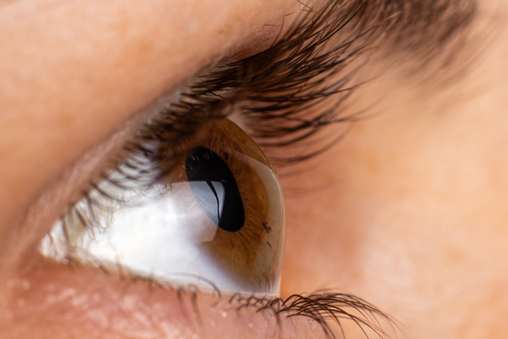 Keratoconus 2 degree - eye disease, thinning of the cornea in the form of a cone. The cornea plastic