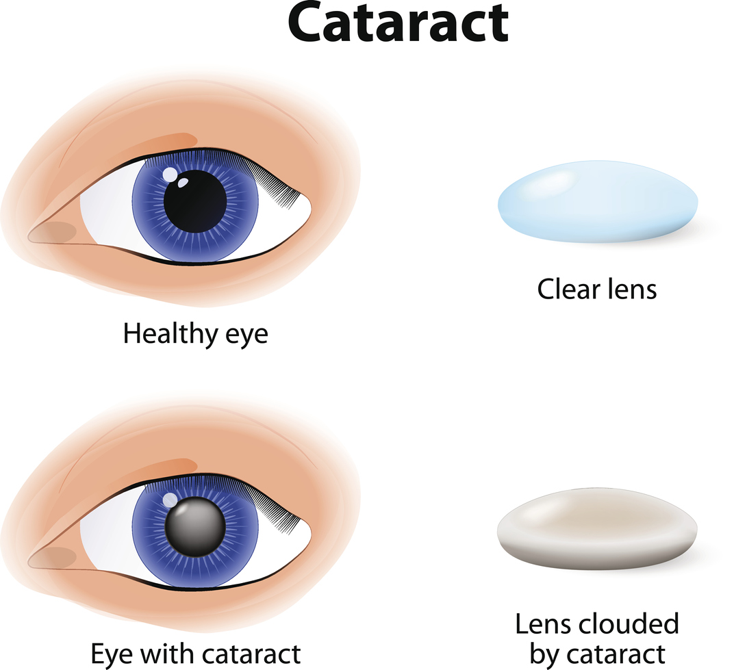 cataract is a clouding crystalline lens